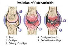 Osteoarthritis: Our Aging Joints
