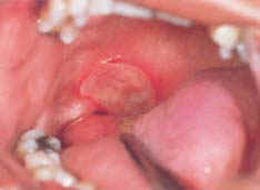 major apthous ulcer
