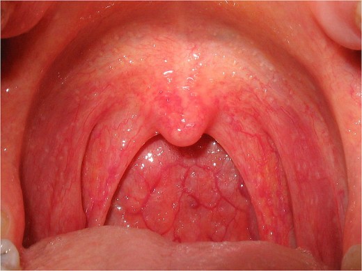 A throat with pharyngitis will appear red and swollen, and may have white spots in the back of the throat