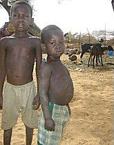 Niger childhood malnutrition