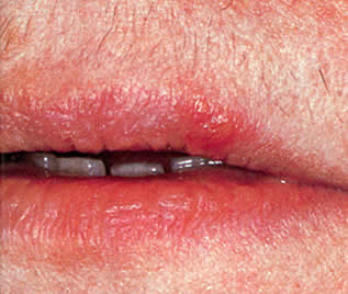 Herpex simplex infection of mouth.