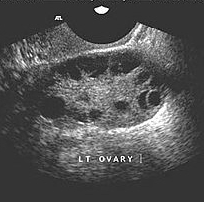 A typical scan image of an ovary in polycystic ovarian syndrome (PCOS). The numerous small round cysts (appearing black) can be seen 'surrounding' the ovary. It is this finding that gives the condition its name 'polycystic'