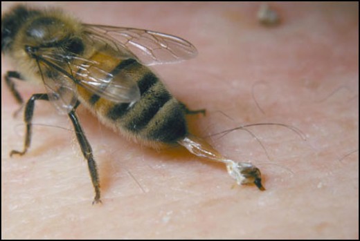 Bee stings