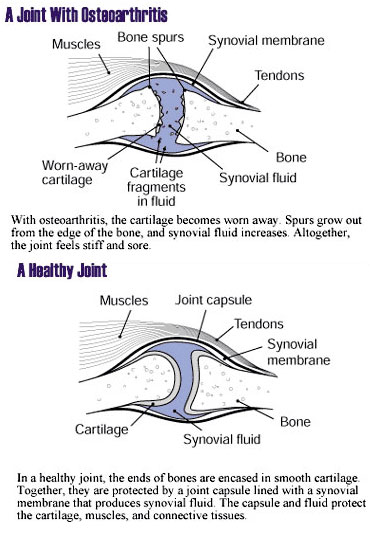 Image provided by the National Institute of Arthritis and Musculoskeletal and Skin Diseases (NIAMS)