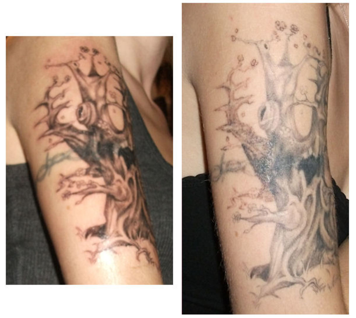 Natural Tattoo Removal