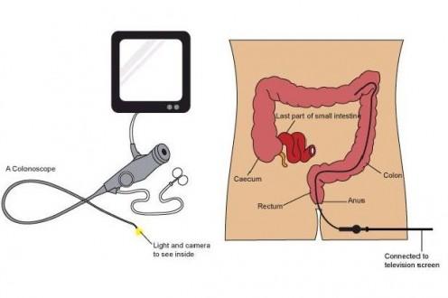 Diagram of A Colonoscopy