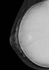 Mammogram Picture Showing A Breast Implant.