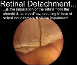 What is Retinal Detachment