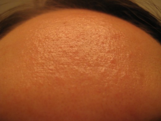 My forehead after using lemon juice... there were zero spots on it before and now it's covered in dots.  I'm thinking my skin is irritated.  I'll let it rest now.
