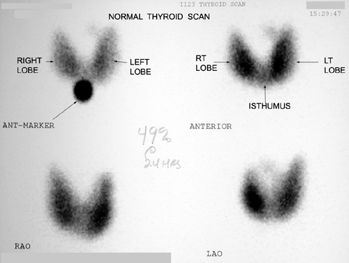 Normal Thyroid Scan Results