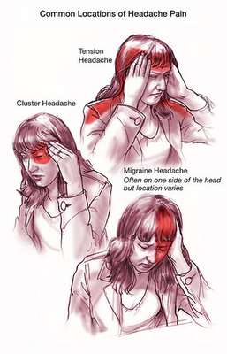 Treatment for migraine and Headache pain