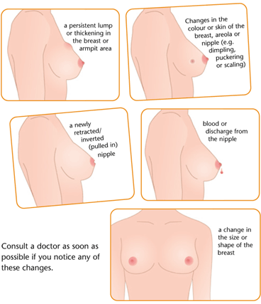 Breast Cancer Symptoms