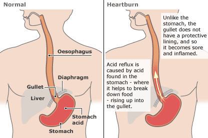 In this diagram you can see what causes acid reflux and heart burn. 