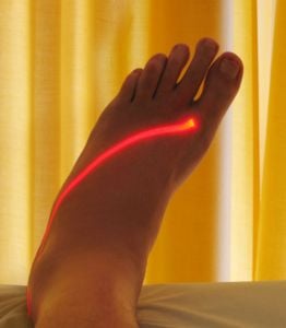 Laser Therapy on the foot. Physical Therapist is the most advertised job in USA in September 2011.