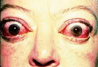 Woman with bulging eyes due to Grave's disease