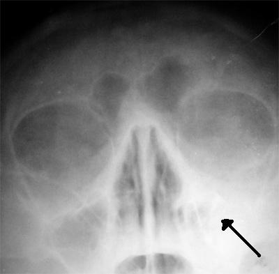 X-ray of a person with Sinusitis.