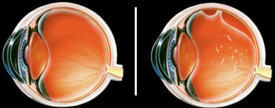 Left: A healthy eye. Right: An eye with retinal detachment. Click for larger image. (©SFG)