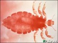 Head Lice-How to Recognize, Treat and Prevent