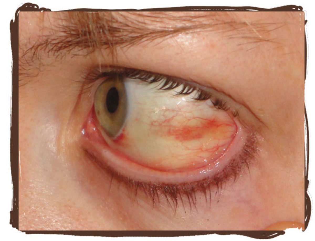 Why Did My Eye Turn Red Subconjuctival Hemorrhage Patients Lounge
