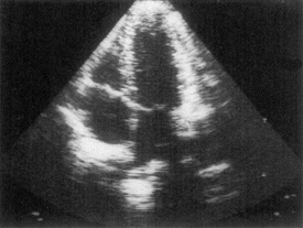 The Echocardiogram here, shows the hearts ventricles, right and left respectively at the top. They are separated by the mitral valve. At the bottom of this image are the Atria. They in turn are separated by the tricuspid valve. 