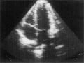 Echocardiograms-Taking A Closer Look At The Human Heart.
