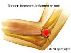 Tips on How to Treat Tennis Elbow at Home