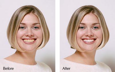teeth whitening, before and after