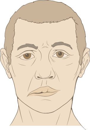 With Bell's Palsy the affected side becomes droopy and has no muscle movement
