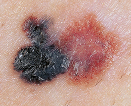 Reservatrol when applied upon melanoma's like the one shown in this photo, have been shown to significantly reduce the spread of the cancer. Tests of mice have confirmed this evidence.