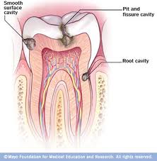 Cavity is a hollow within a solid body; It is a decay part of tooth.