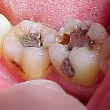 picture of a decay tooth.