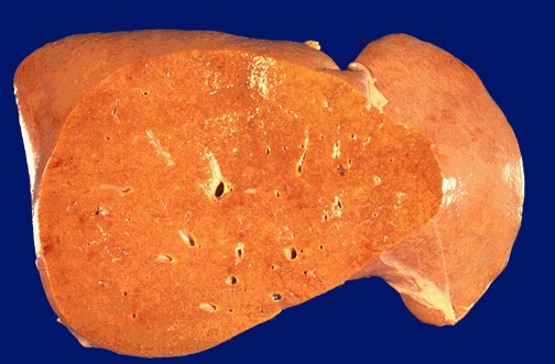 Fatty liver is grossly enlarged, yellow, and greasy and firm with a smooth and glistening capsule. 