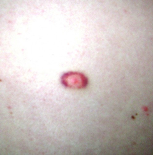 Rash can be much larger, spreading outward.  