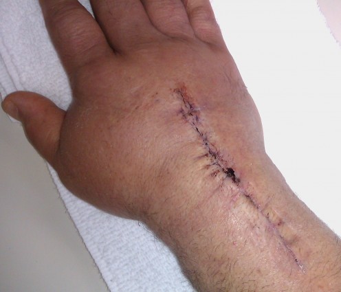 A "Proximal Row Carpectomy" with tendon transfers can leave you with a lot of physical therapy afterwords.