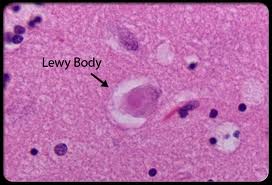 Lewy bodies