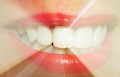 Teeth Whitening. Dentist or Home? Effectiveness and Affordability