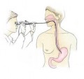 Reasons To Have An Endoscopy.