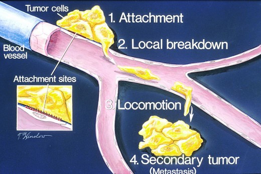 Process of Metastasis. Source: Wikimedia Commons, Public Domain. 