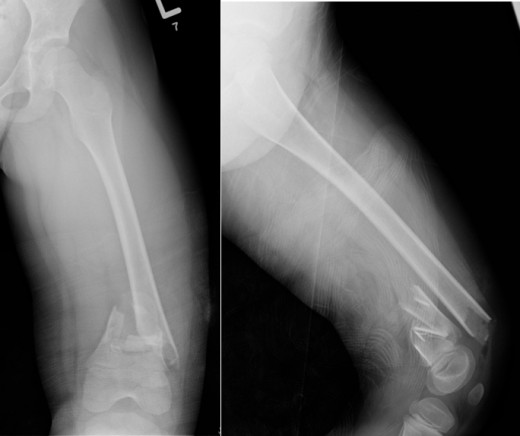 Salter-Harris II fracture of the distal femur