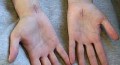Understanding Carpal Tunnel-A Foe To Many Including The Writer.