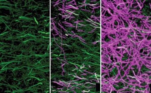 Axons (green) in mouse hippocampus lose all myelin, (center) after 12 weeks of cuprizone treatment, spontaneous remyelinization (purple) occurs, by applying ILF therapy remyelinization is greatly increased (right).