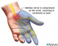 Why Does My Hand Cramp and Twitch? Is it Carpal Tunnel Syndrome? | Healdove