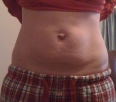 view of my diastasis from the front