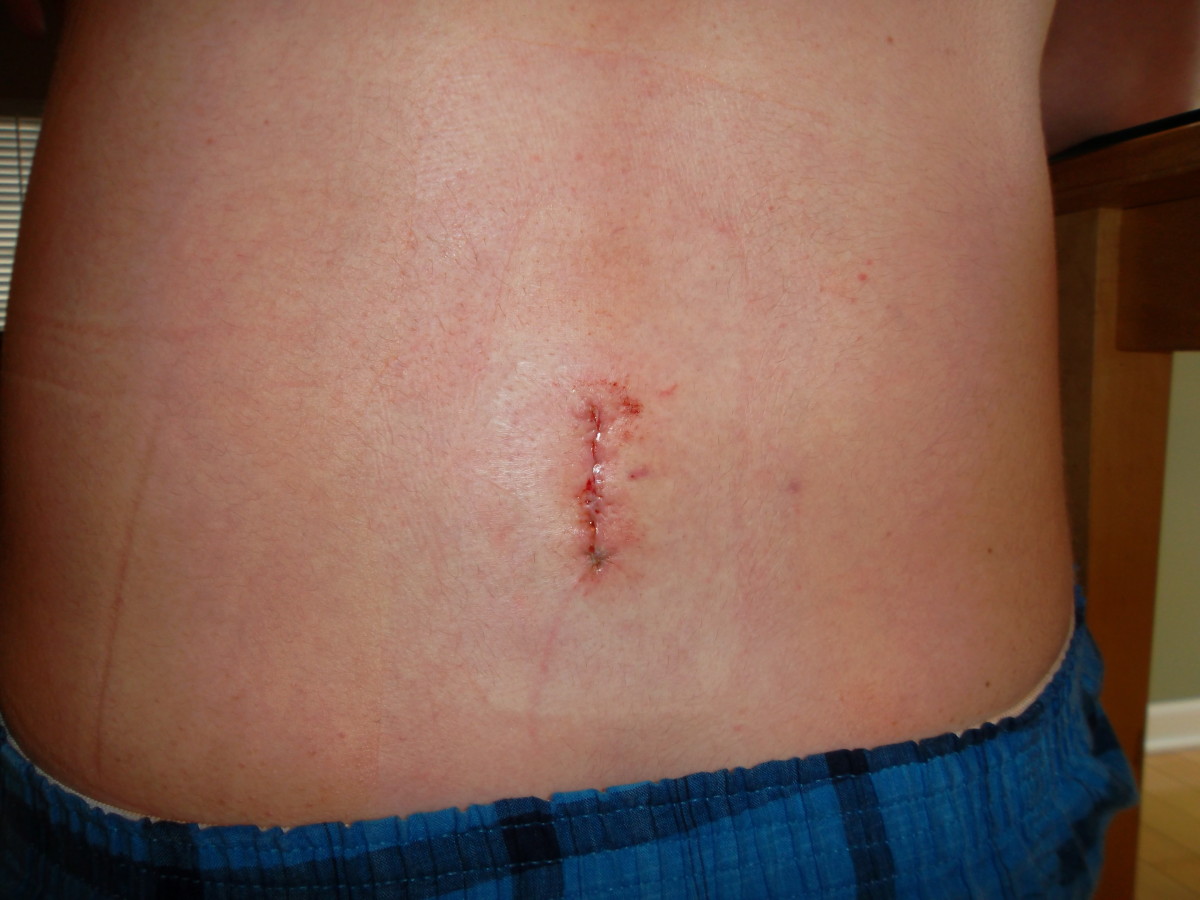 What is the estimated recovery time for lower back surgery?