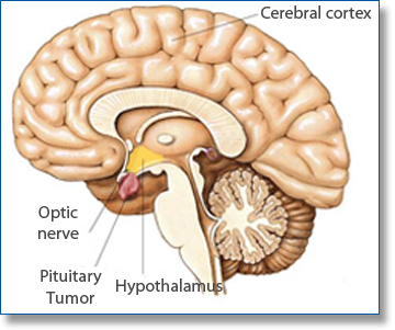 Tuumor on the Pituitary Gland