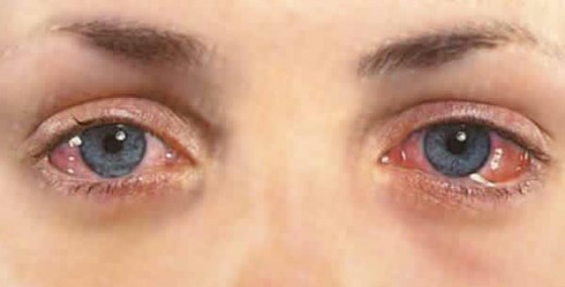 Why do your Eyes Turn Red?