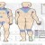The distribution of Acanthosis Nigricans in the body. The distribution of Acanthosis Nigricans in the body.