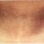 Acanthosis Nigricans in the front of neck. Acanthosis Nigricans in the front of neck.