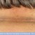 Acanthosis Nigricans in the back of neck. Acanthosis Nigricans in the back of neck.