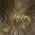 Acanthosis Nigricans in the scalp. Acanthosis Nigricans in the scalp.